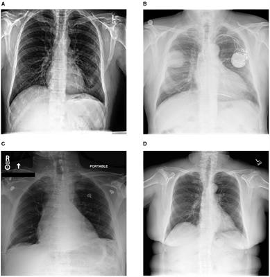 ChestBioX-Gen: contextual biomedical report generation from chest X-ray images using BioGPT and co-attention mechanism